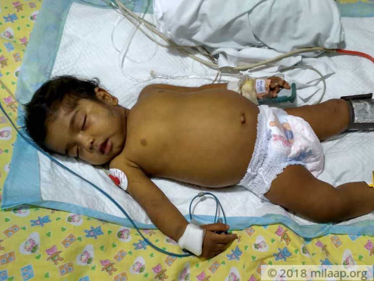 My 9 MonthOld's Stomach Has Bloated So Much That He Cannot Milaap